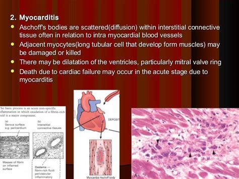 5 Rheumatic Heart Disease Pathology