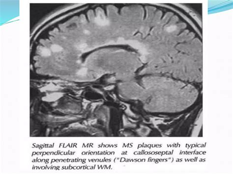 Radiology Of Demyelinating Diseases Ppt