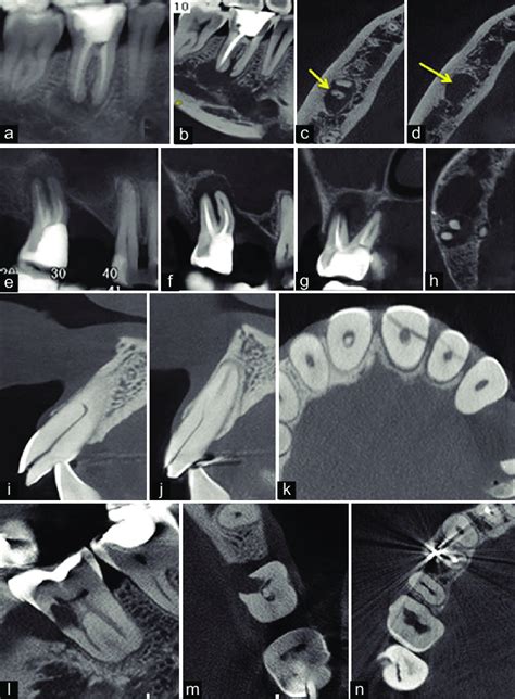 A A Cone Beam Computed Tomography Cbct Panoramic Reconstruction Of Download Scientific