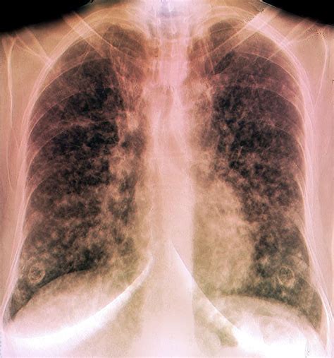 Terminal Lung Cancer Photograph By Zephyr Science Photo Library Fine