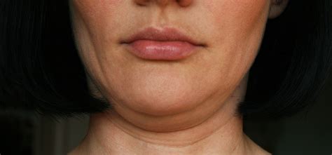 Double Chin Treatments McLean Potomac Dermatology