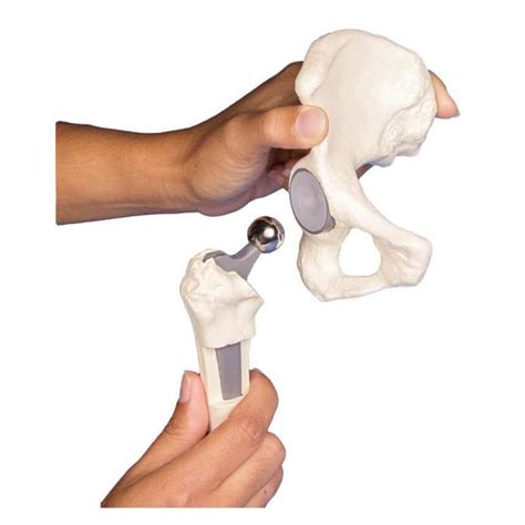 Erler Zimmer Hip Implant Model Doccheck Shop