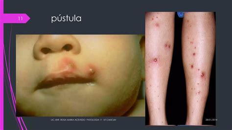 Lesiones Cutaneas Ppt