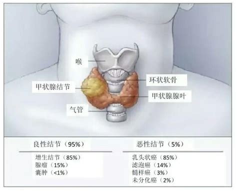 發現甲狀腺有結節之後我們應該做什麼，各類指南又是如何規範的 每日頭條