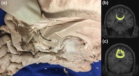 Callosal fibers. A dense commissural fiber bundle, depicted by the ...