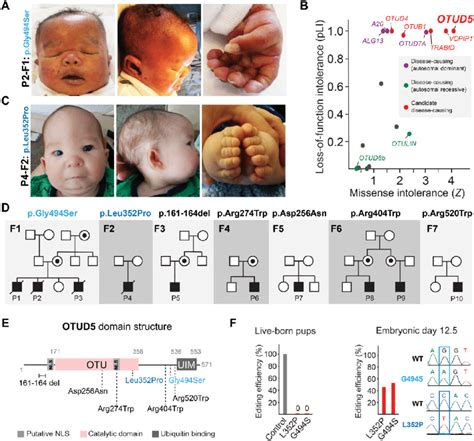 Hemizygous variants in OTUD5 cause multiple congenital anomaly ...