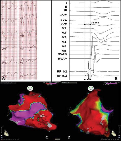 Electrocardiogram And Electro Anatomical Maps Of Case A Twelve Lead