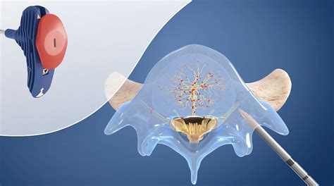 Intracept procedure