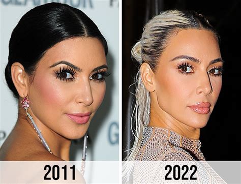 Kim Kardashian Plastic Surgery Before And After