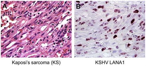 A Kaposis Sarcoma Micrograph Of A Kaposis Sarcoma Lesion Showing