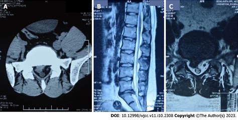 Intervertebral Disc Prolapse Xray