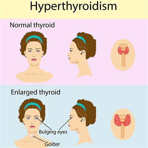 thyroid disease symptoms - DrBeckmann