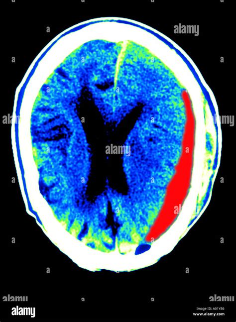 Ct Scan Brain Subdural Hematoma From Trauma Ventricles Compressed And