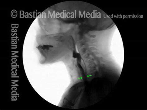 Cricopharyngeal Myotomy Cpm Treatment For Ar Cpd