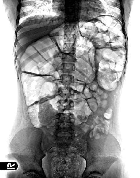 567 Abdominal Adhesions Images Stock Photos 3d Objects And Vectors