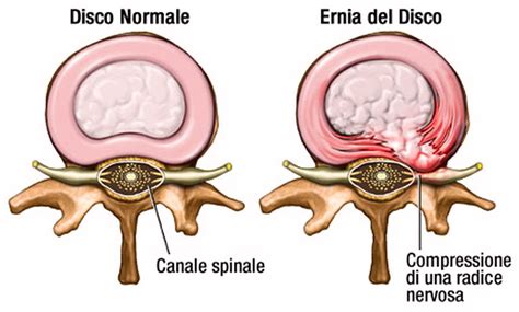 Ernia Del Disco Cause Sintomi E Terapia Conservativa Cgf Cesano