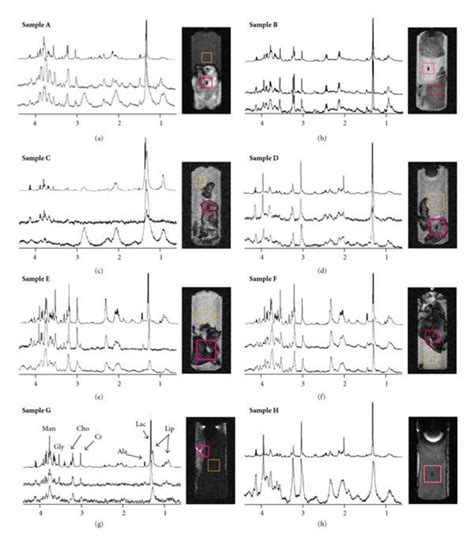 Hrmas Cpmg Top And Mrm Spectroscopy Press Single Voxel Spectra From