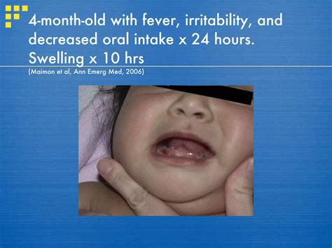 Ludwigs Angina And Anaesthetic Management Ppt