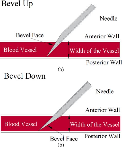 Figure 1 from Investigation of Needle Bevel Face Up and Down ...