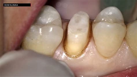 Gingival Electro Retraction Youtube