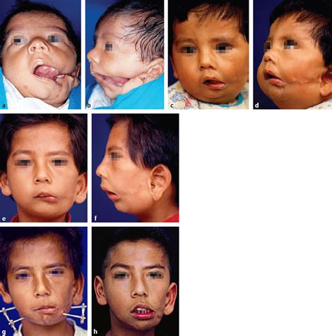 Orofacial and Craniofacial Deformities | Plastic Surgery Key