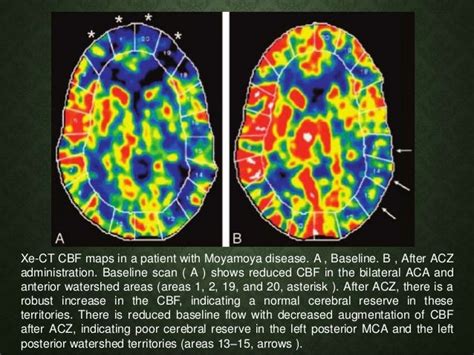 Measurement of Cerebral Blood Flow