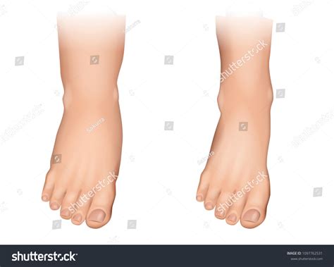 Vektor Stok Vector Illustration Edema On Feet Swelling Tanpa Royalti