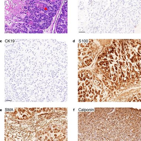 H E And IHC Staining In The Myoepithelial Subtype Of IMPA A H E