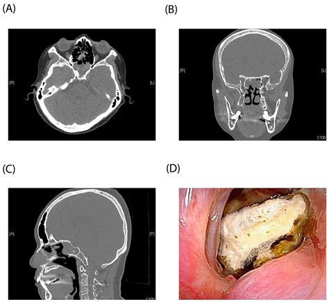 Diagnostics Free Full Text Risk Factors For Isolated Sphenoid Sinusitis After Endoscopic