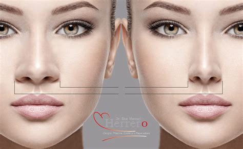 Rinoplastia Clinica Dr Manuel Herrero