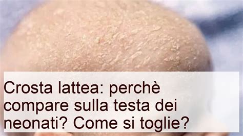 Crosta Lattea Cause E Rimozione Della Dermatite Seborroica YouTube