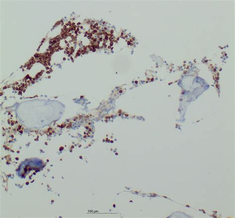 The Neoplastic Plasma Cells Ex [image] Eurekalert Science News Releases