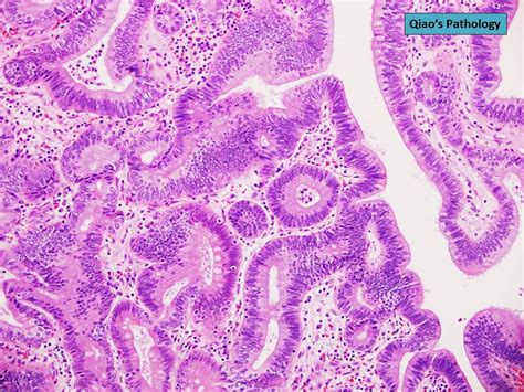 Qiaos Pathology Papillary Adenoma Of The Gallbladderintracystic Papillary Neoplasm Icpn Of