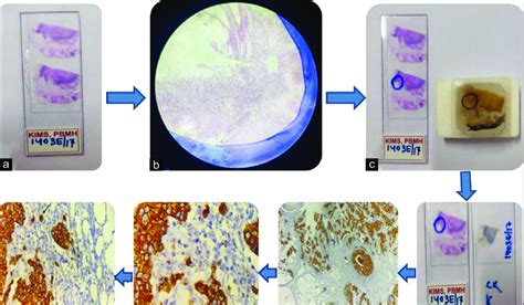 A Proper Histopathology Slide Was Selected B An Invasive Front Of