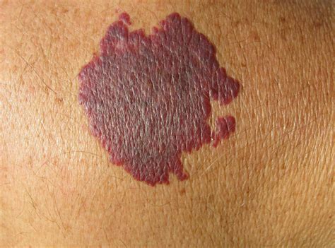 Weekly Pdl Treatments Associated With Improved Port Wine Birthmark