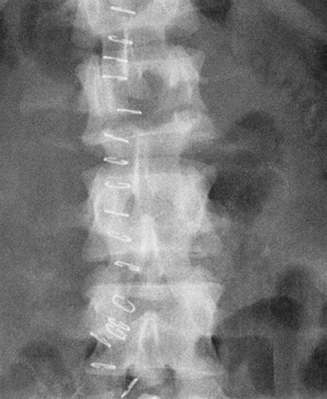 Chance Type Fractures Of The Thoracolumbar Spine Imaging Analysis In