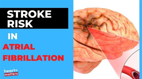 Atrial Fibrillation Af And The Risk Of Stroke Youtube