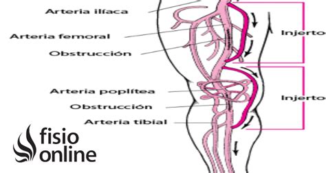 Poplítea Arteria Qué Es Ubicación Recorrido Ramificaciones Y Lesiones