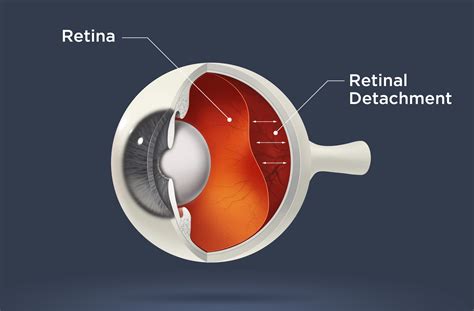 Detached Retina, also Retinal Detachment - AllAboutVision.com