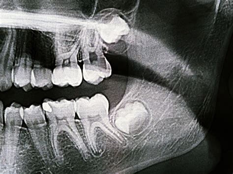 As Es Como Se Observa La Caries Dental En Una Radiograf A