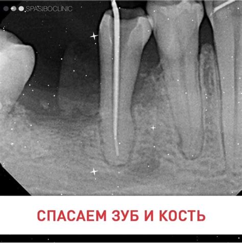 СПАСАЕМ ЗУБ И КОСТЬ | Спасибо.Клиник | Дзен