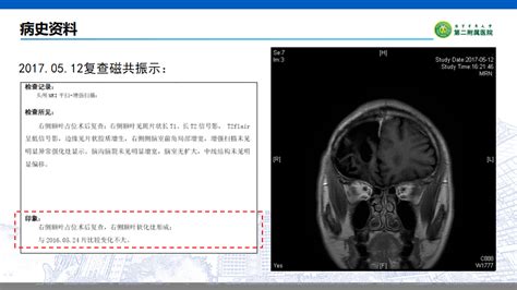 【会议报道】四川大学华西医院胶质瘤多学科诊疗（mdt）院际交流恶性肿瘤患者诊断