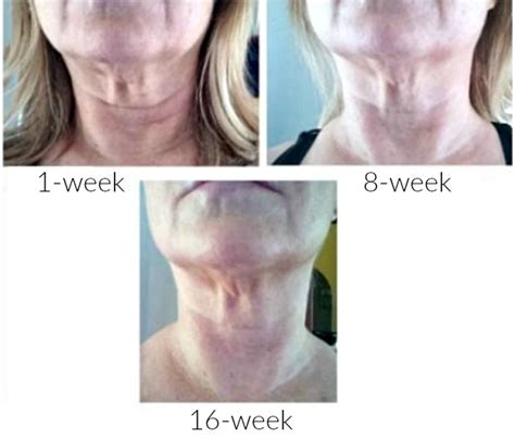 Sagging Neck Skin | How to Reduce and Prevent Wrinkles and Sagging