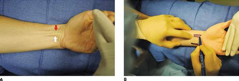 Wrist Block Hadzics Peripheral Nerve Blocks And Anatomy For