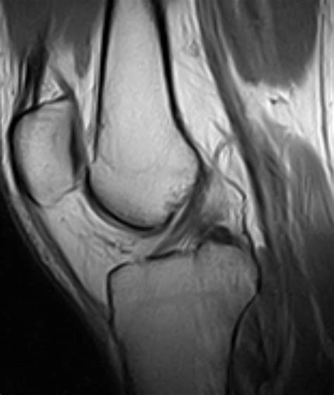 Knee-Normal ACL-PDW sagittal slice 0.25T MRI | Bayside Standing MRI