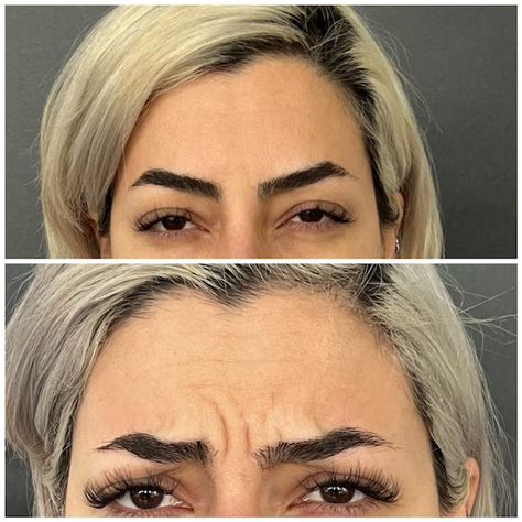 Anti Wrinkle Treatment In Bromley Beutiva