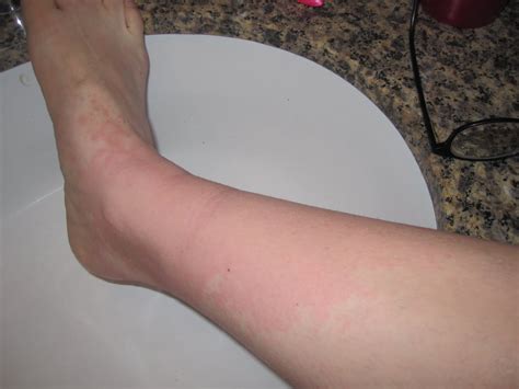 Can Uncontrolled Diabetes Cause Weight Loss Ankle Itch No Rash Low