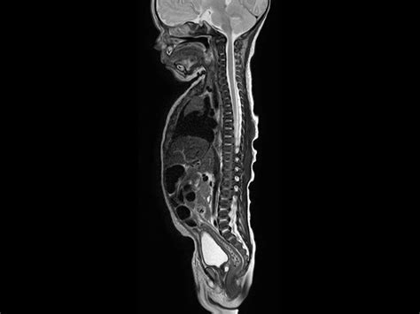 Pediatric Total Spine With Spina Bifida Philips Mr Body Map