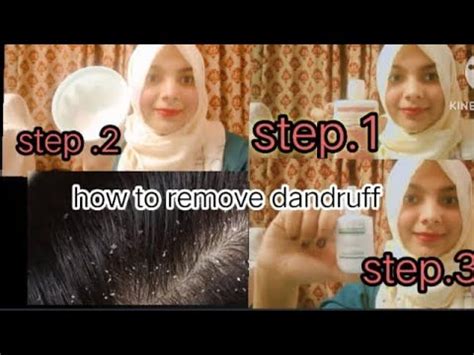 Remove Dandruff With 3 Eassy Steps Itchy Dry Scalp How To Treat