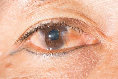 Pinguecula And Pterygium New Jersey Eye Center